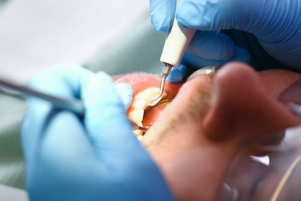 Best Emergency Dentist for Knocked-Out Tooth in Arcadia, FL